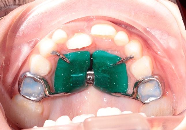 кривые зубы ребенка до начала лечения