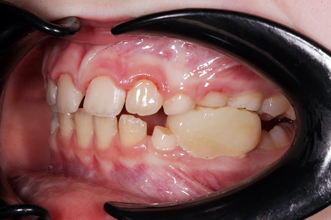 лечение зубов в детской стоматологии