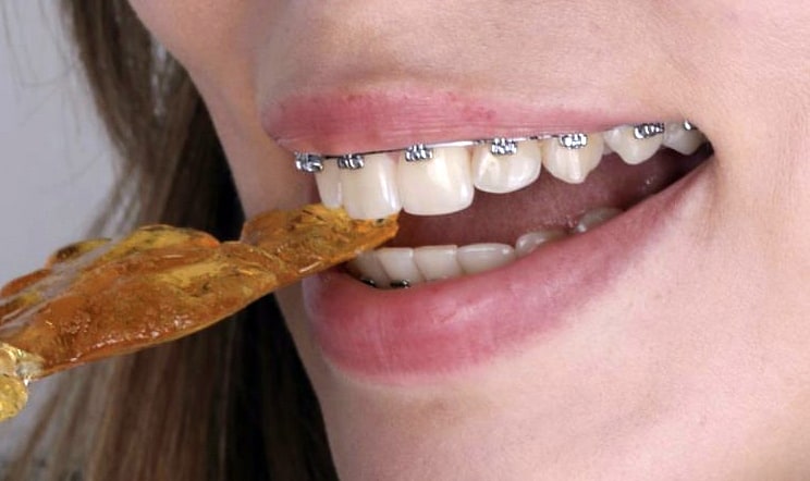 как выглядят металлические брекеты  Pitts 21 на зубах